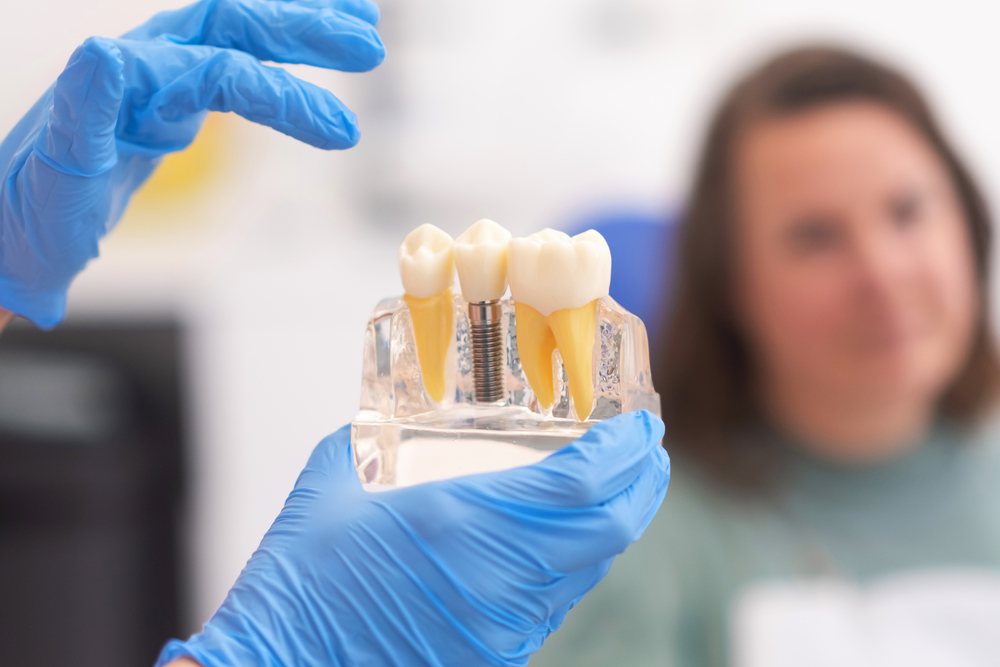 Are There Advantages To Having Biocompatible Dental Implants?